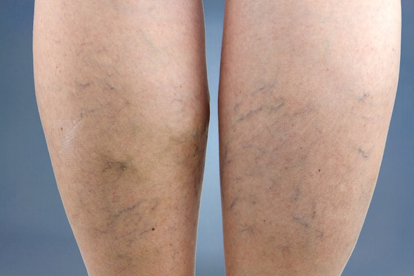 Woman's calves with veins showing