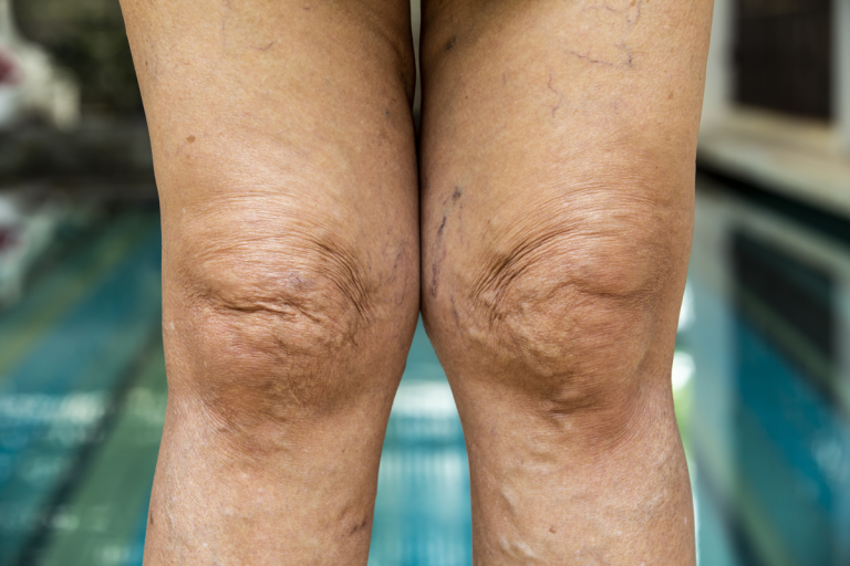 Older woman's legs and knees before Sculptra & Radiesse Treatment for Sagging Knees and varicose veins