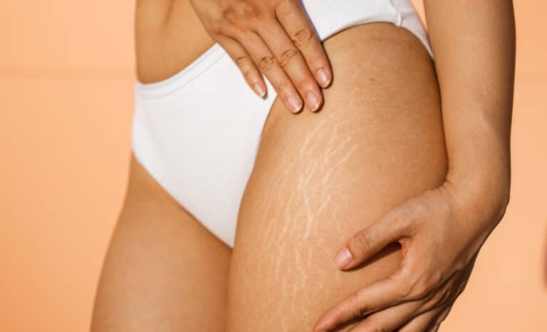 Woman before Stretch Mark Treatments